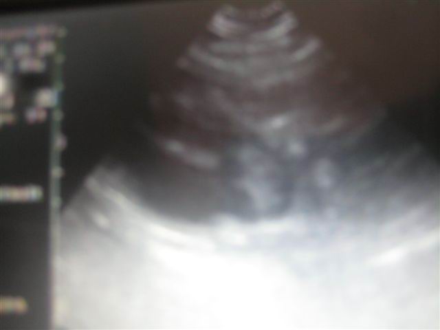 10 mrt 2012, 2e foto van de drachtigheidscan